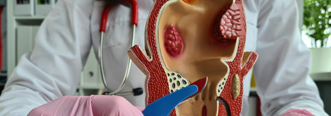 Addressing hemorrhoidal issues